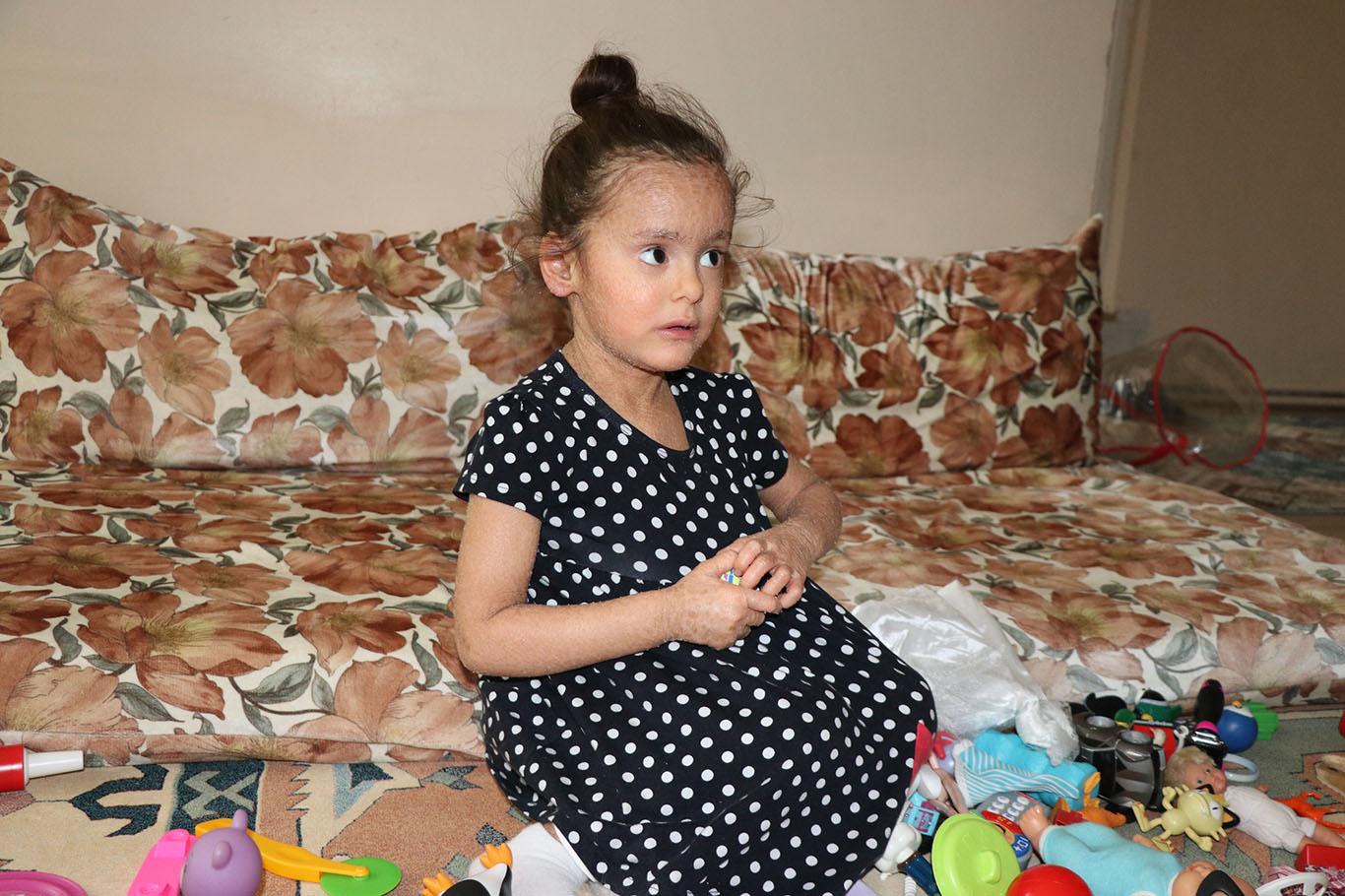 İktiyozis hastası minik çocuk yardım bekliyor İktiyozis hastası minik çocuk yardım bekliyor
